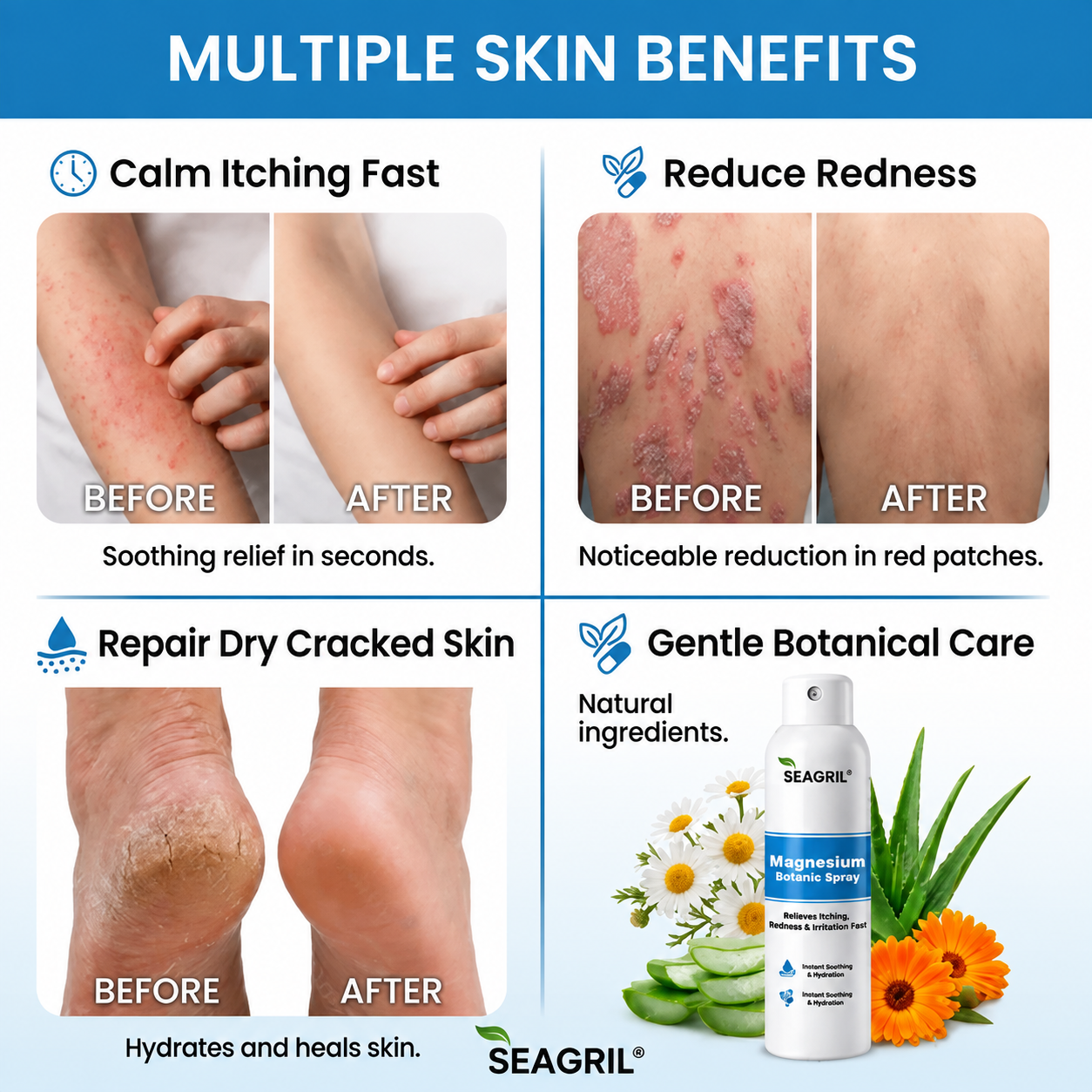 SEAGRIL® Magnesium Botanic Spray| Advanced Skin Recovery for Psoriasis & Eczema | Rapid Soothing, Steroid-Free