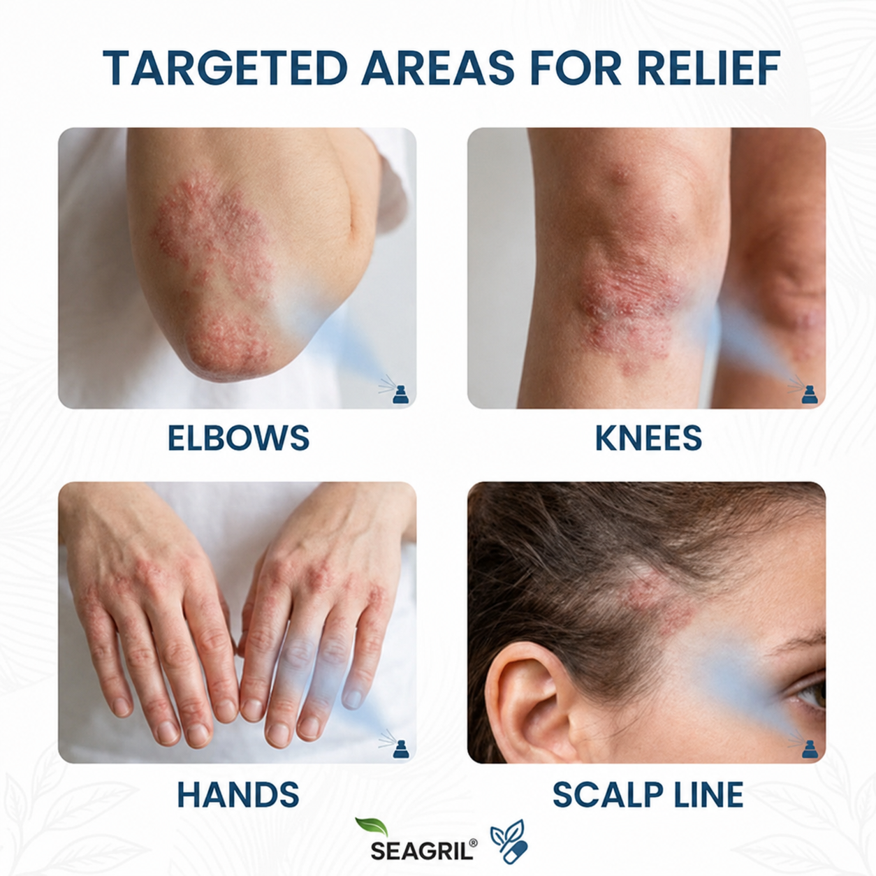 SEAGRIL® Magnesium Botanic Spray| Advanced Skin Recovery for Psoriasis & Eczema | Rapid Soothing, Steroid-Free
